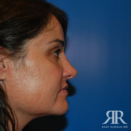 Female Rhinoplasty