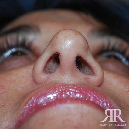 Female Rhinoplasty