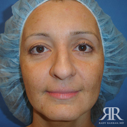 Female Rhinoplasty