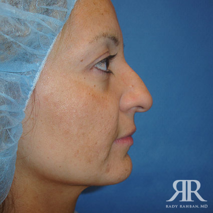 Female Rhinoplasty