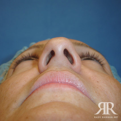 Female Rhinoplasty