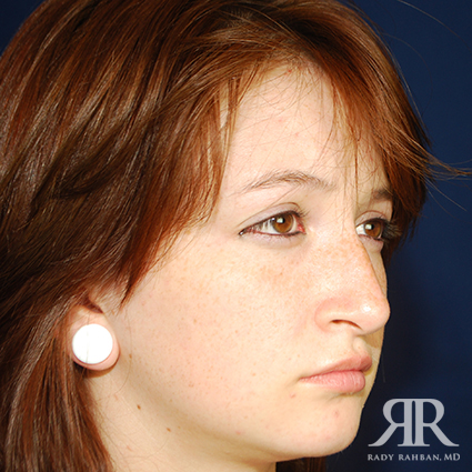 Female Rhinoplasty