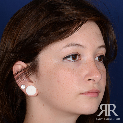 Female Rhinoplasty