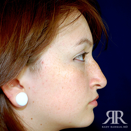 Female Rhinoplasty