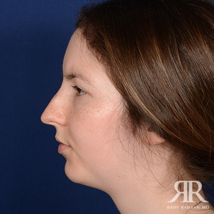 Female Rhinoplasty