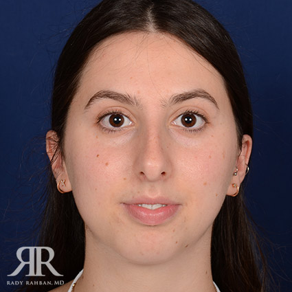 Female Rhinoplasty