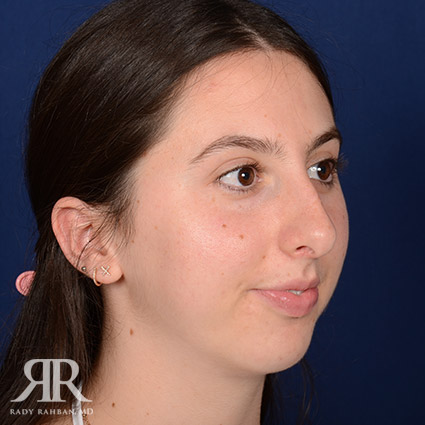 Female Rhinoplasty