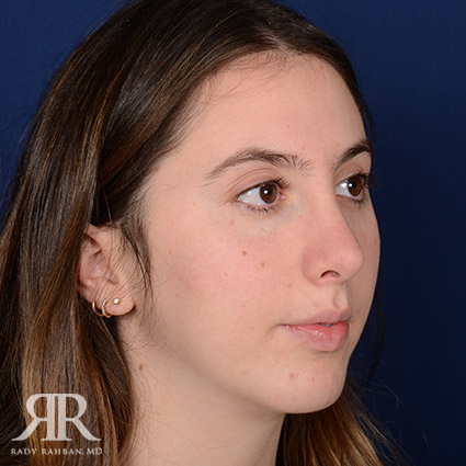 Female Rhinoplasty