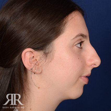 Female Rhinoplasty