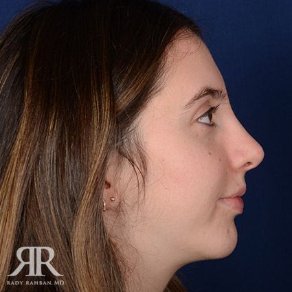 Female Rhinoplasty