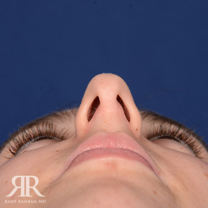 Female Rhinoplasty