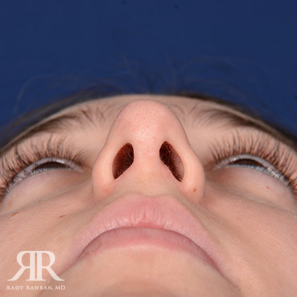 Female Rhinoplasty