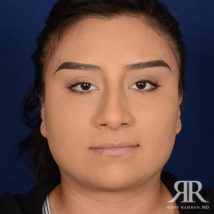 Female Rhinoplasty