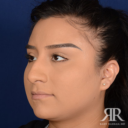 Female Rhinoplasty