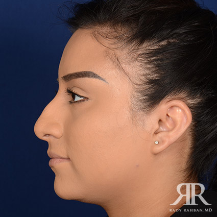 Female Rhinoplasty