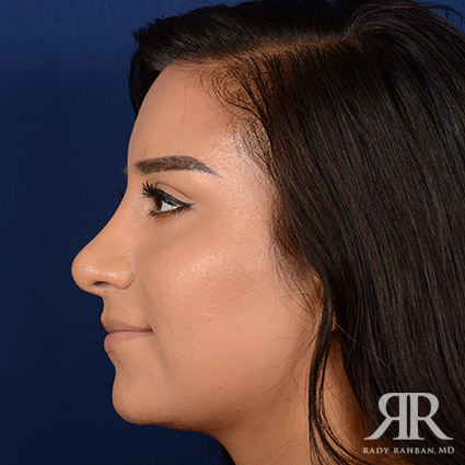 Female Rhinoplasty