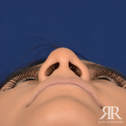 Female Rhinoplasty