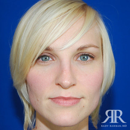 Female Rhinoplasty