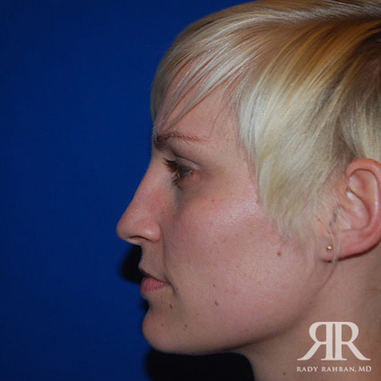 Female Rhinoplasty