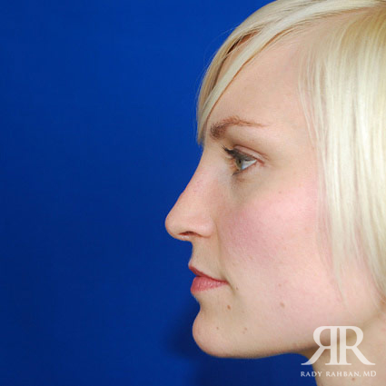 Female Rhinoplasty