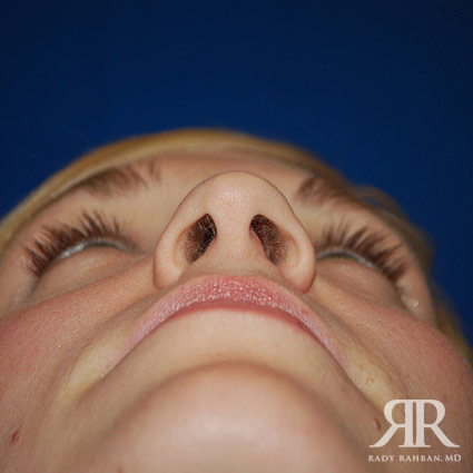 Female Rhinoplasty