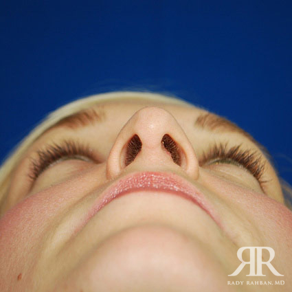 Female Rhinoplasty