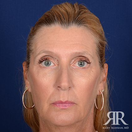 Female Rhinoplasty