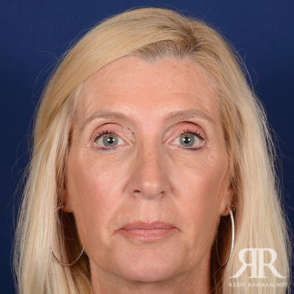 Female Rhinoplasty