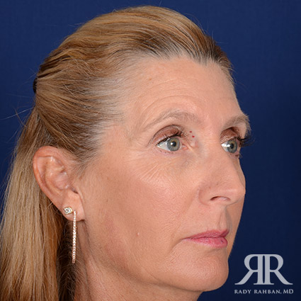 Female Rhinoplasty