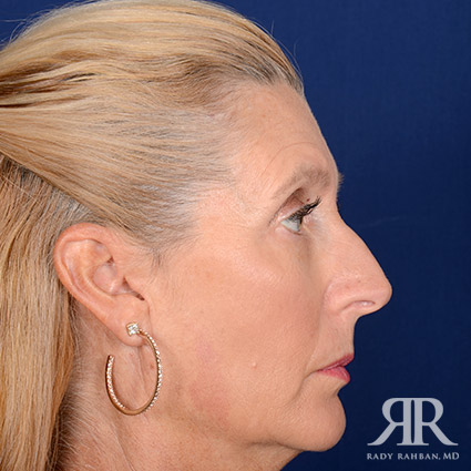 Female Rhinoplasty