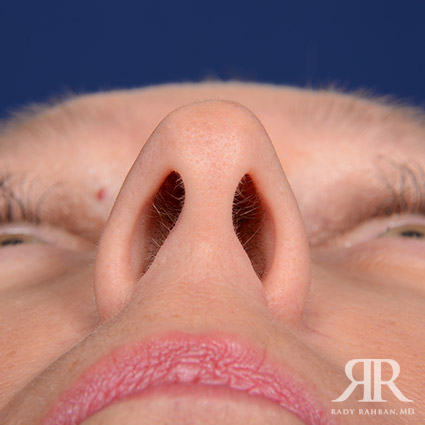 Female Rhinoplasty