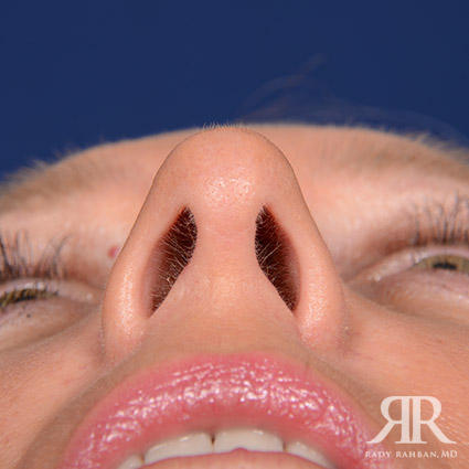 Female Rhinoplasty