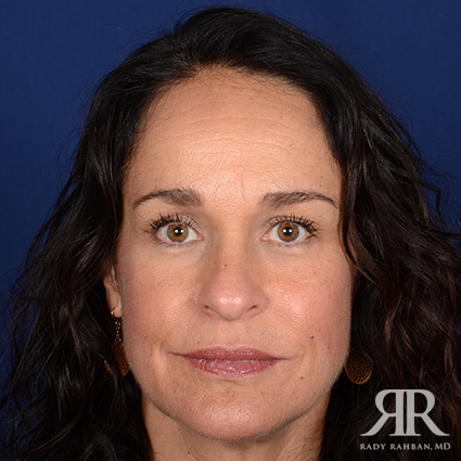 Female Rhinoplasty