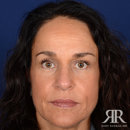 Female Rhinoplasty