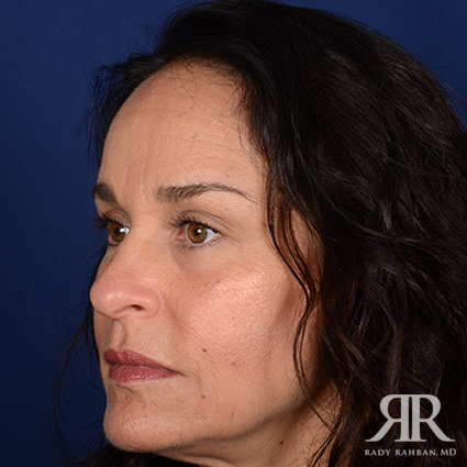 Female Rhinoplasty