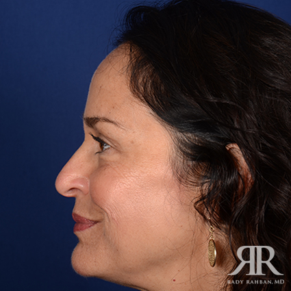 Female Rhinoplasty