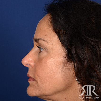 Female Rhinoplasty