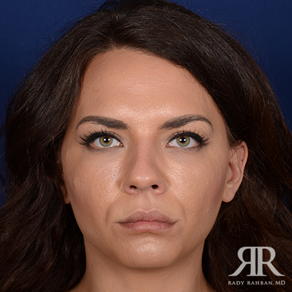 Female Rhinoplasty