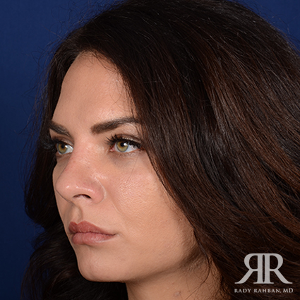 Female Rhinoplasty