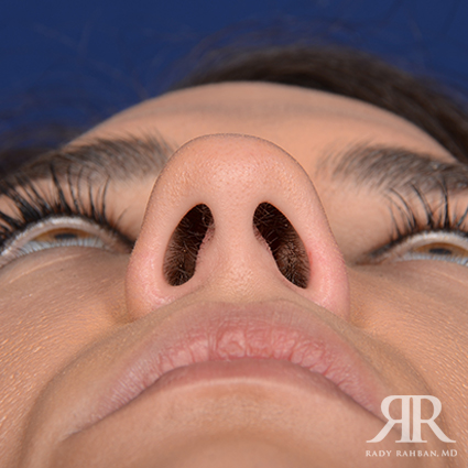 Female Rhinoplasty