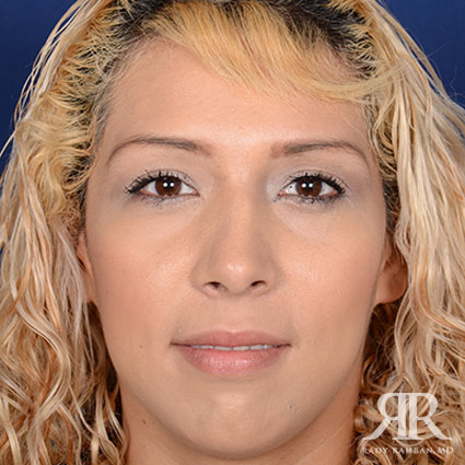 Female Rhinoplasty