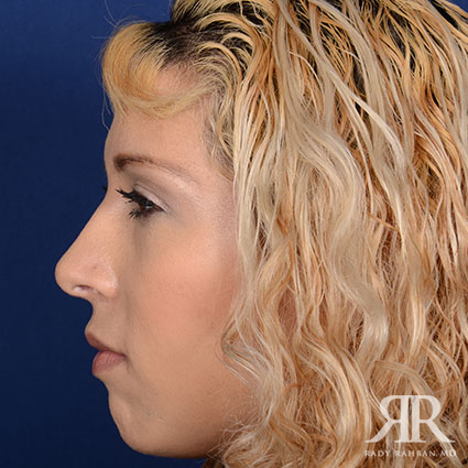 Female Rhinoplasty