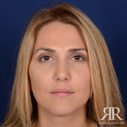 Female Rhinoplasty