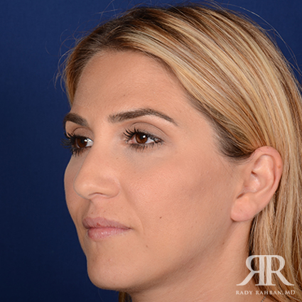 Female Rhinoplasty