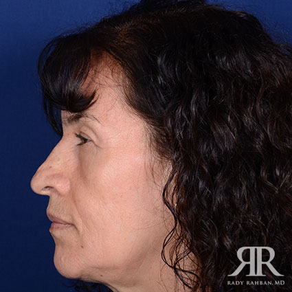 Female Rhinoplasty