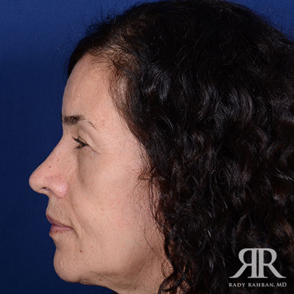 Female Rhinoplasty