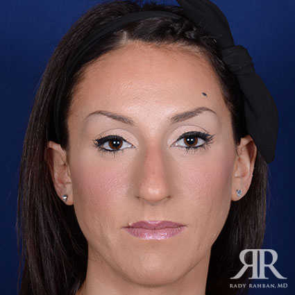 Female Rhinoplasty