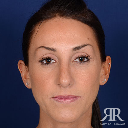 Female Rhinoplasty