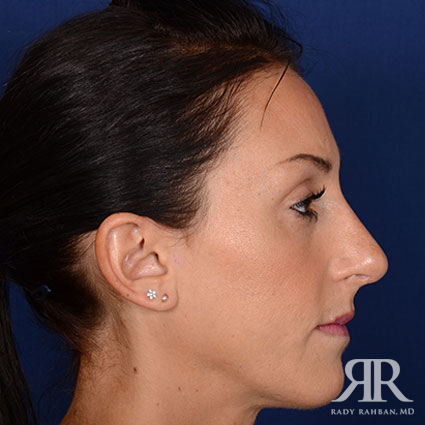 Female Rhinoplasty