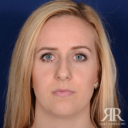 Female Rhinoplasty